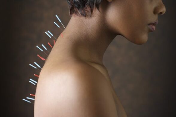 acupuncture against back pain