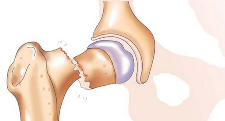 A femoral neck fracture is accompanied by severe hip joint pain