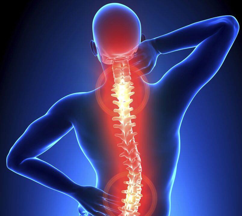 The spine osteochondrosis