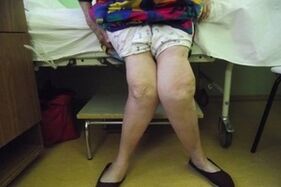 advanced knee arthrosis