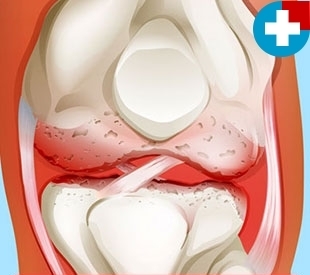 the symptoms of osteoarthritis of the
