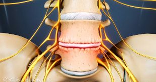 of cervical osteochondrosis
